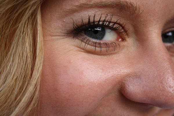Is Botox for Undereye Wrinkles Really Worth It?