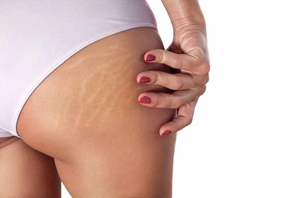 Laser Treatment for Stretch Marks - Does It Work?