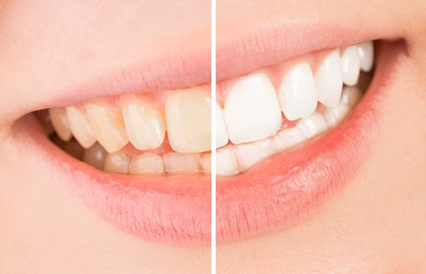 teeth cleaning before and after