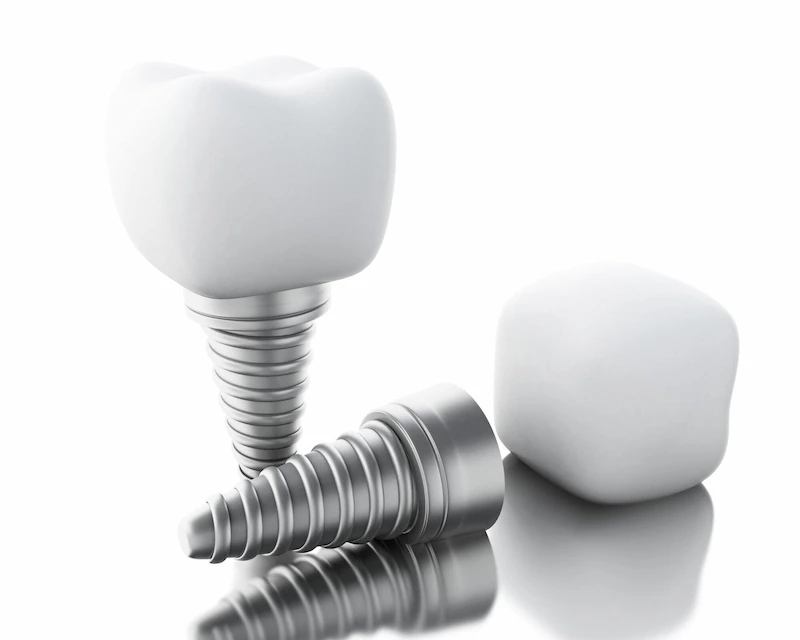 cost of a single tooth implant