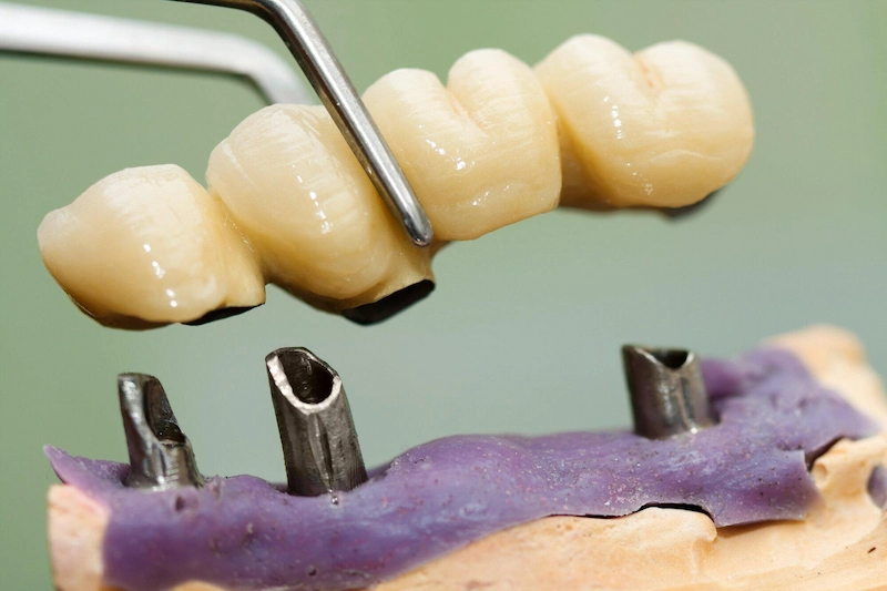 front dental implants